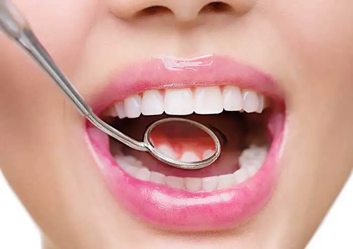 Prevent Cavities Tooth Loss