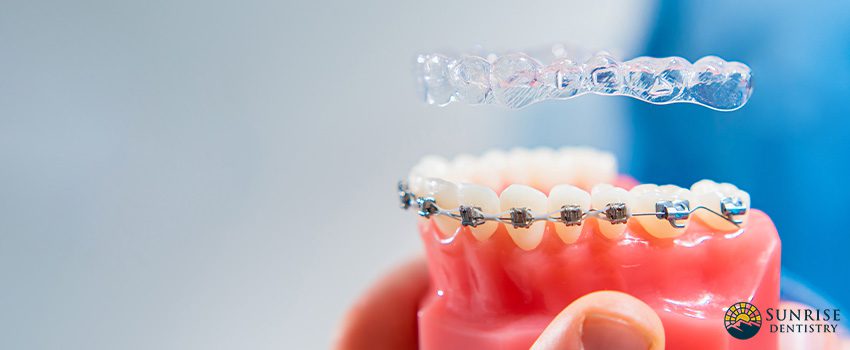 SD Caring for Dental Braces