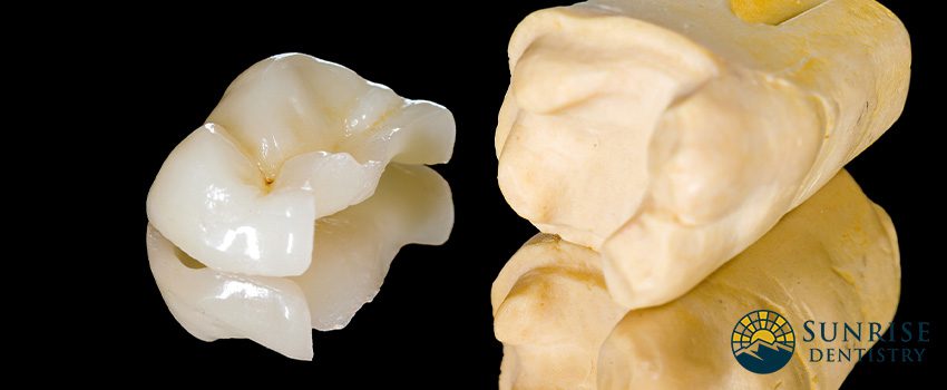 Dental Inlays and Onlays - Everything You Need To Know