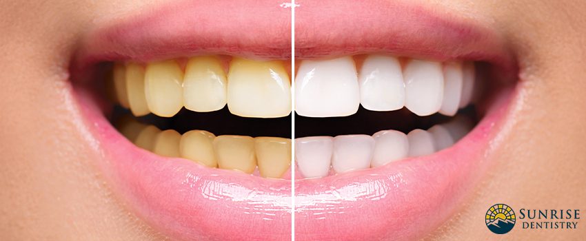 Does Teeth Whitening Work on Dental Restorations