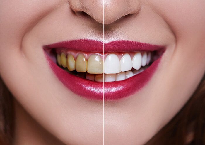 SD Comparison of yellow teeth to white teeth