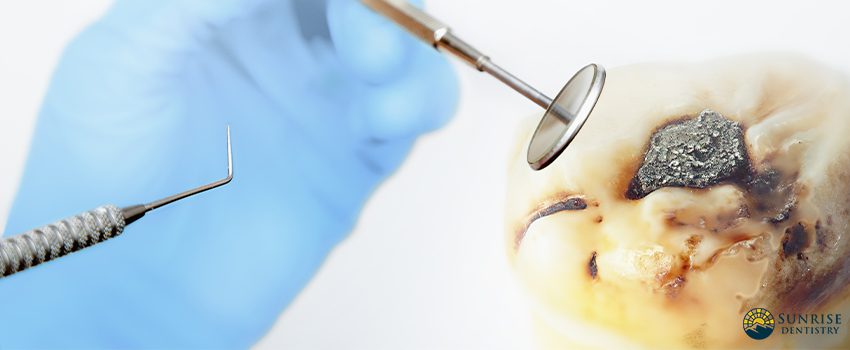 Here's Why You Should Choose Mercury-free Dentistry Services