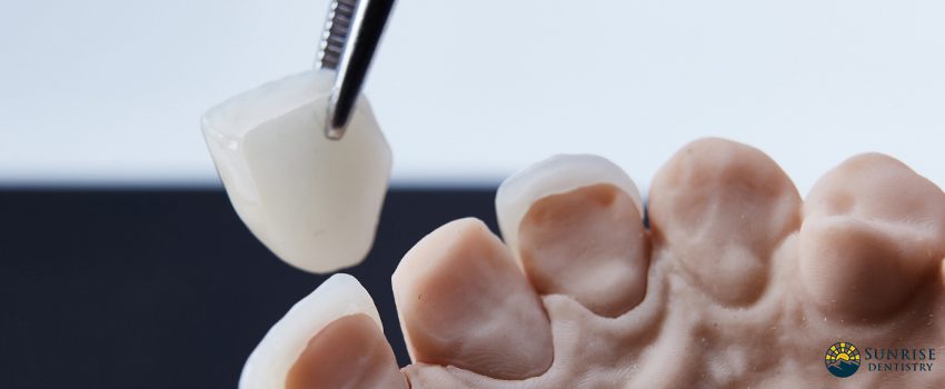 How Long Do Dental Veneers Last