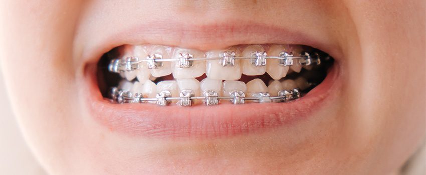 SD How to Fix an Overbite - Causes, Corrections, and More