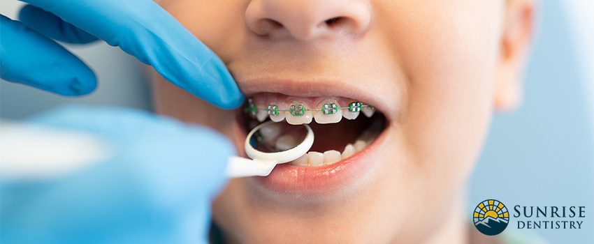 SD How to Take Care of Braces - 8 Habits to Break