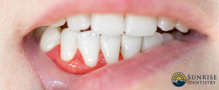 Receding Gums Causes Treatment And Prevention