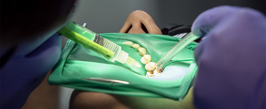 SD Root Canal Indications, Procedure, and Risks