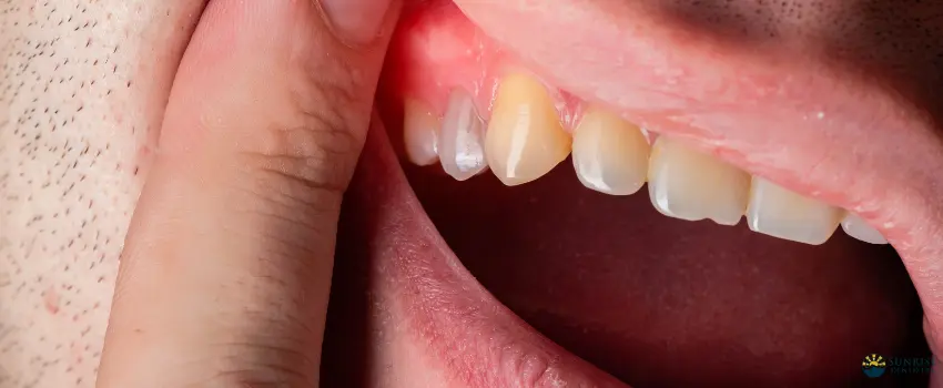 SD-Gum disease is an infection that worsens if you don't address it