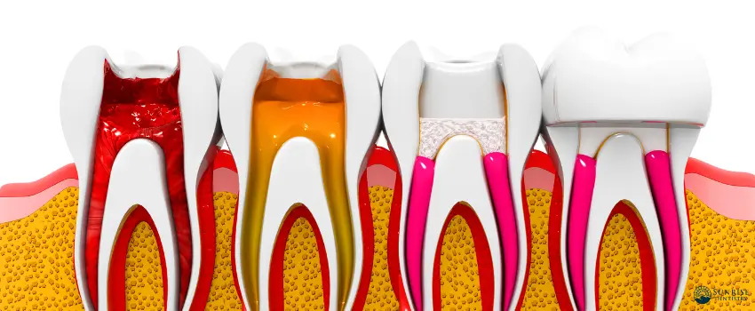 SD-root canal treatment stages