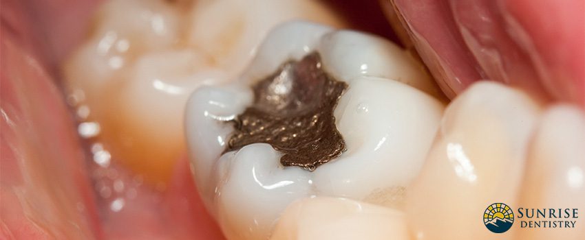 SD Safe Mercury Amalgam Removal Technique - What You Need to Know