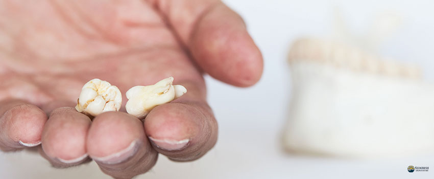 Two extracted wisdom teeth on dentist palm