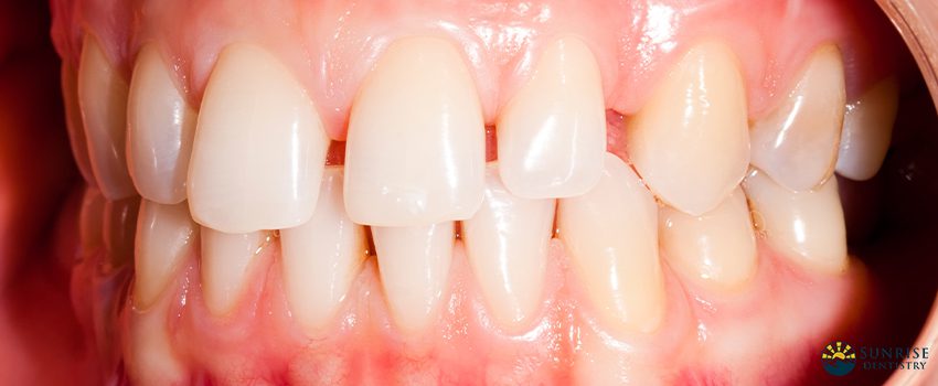 What You Need to Know About Black Triangle Teeth