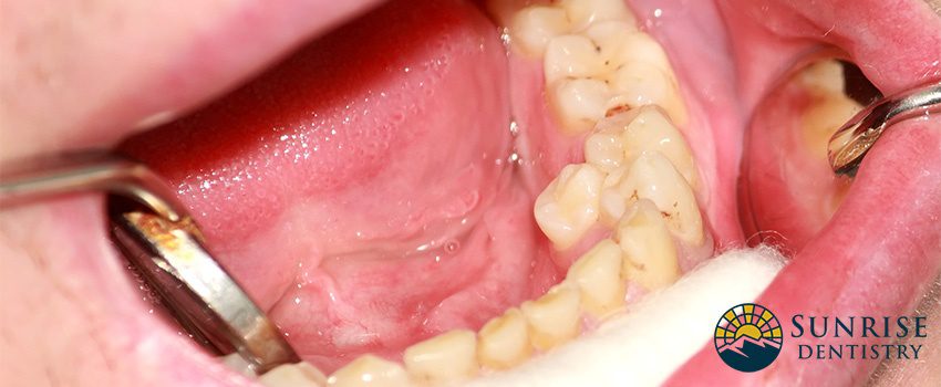 SD What is Hyperdontia - Causes, Symptoms, and Treatments
