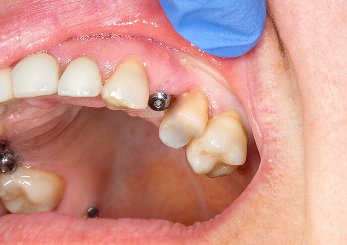 SD Implant on upper teeth in patient