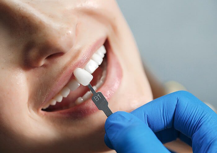 SD Dentist comparing Dental Veneers