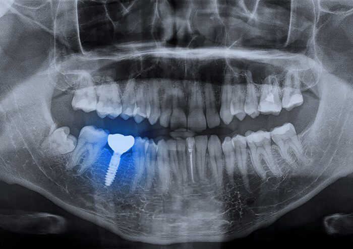 SD Digital Xray Technology