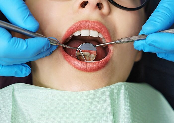 SD Dentist using tools to check back of front teeth of patient