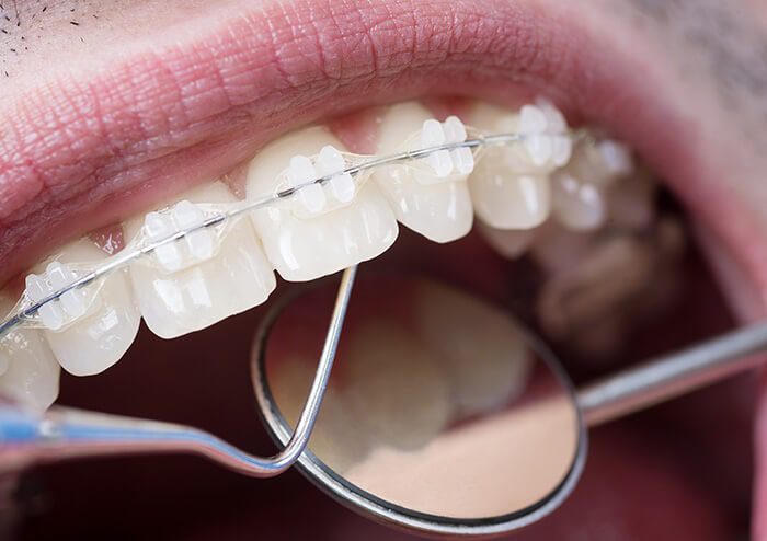 SD Close up of Braces being set on Teeth and checking the back of the front teeth