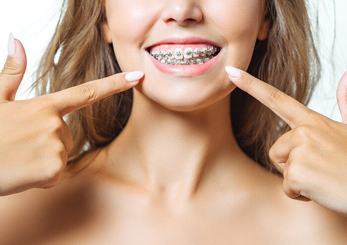 SD Woman Smiling and Pointing at her braces
